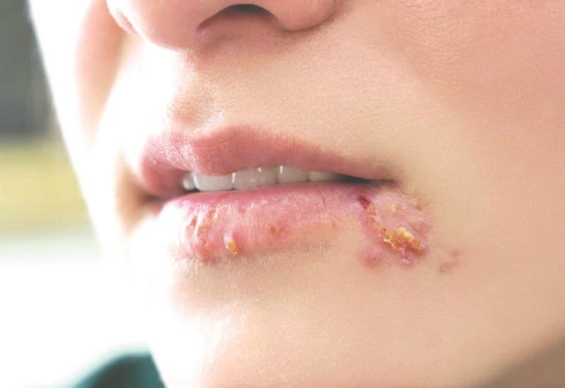Dấu hiệu của phun môi bị nhiễm trùng là lở loét, ngứa ngáy khó chịu