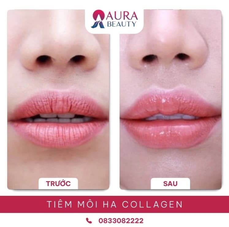 Tiêm môi HA collagen tại Thẩm mỹ Aura
