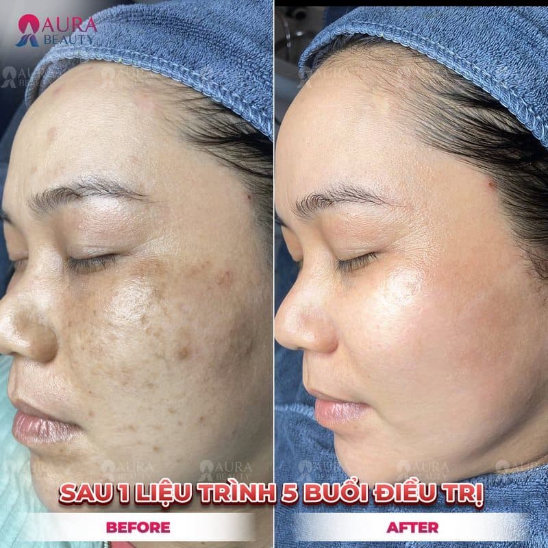Khách hàng trị nám tại Aura