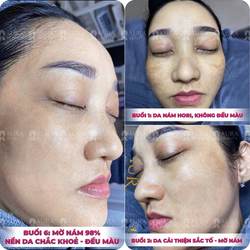 Khách hàng trị nám tại Aura