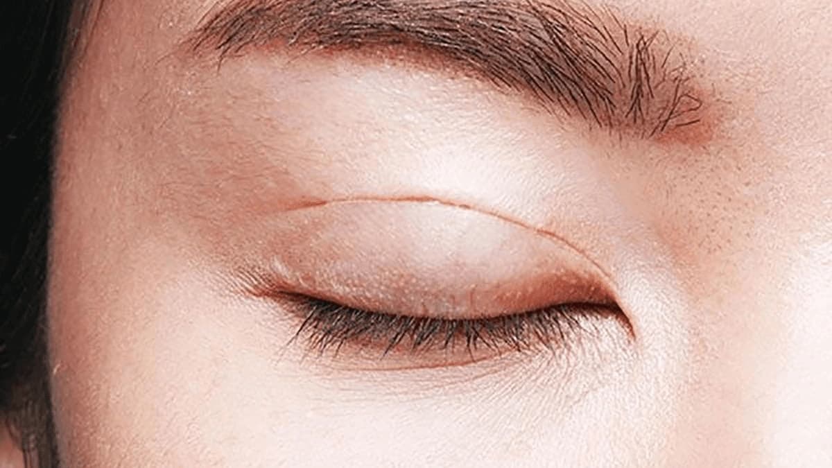 Dấu hiệu nhấn mí bị tuột chỉ