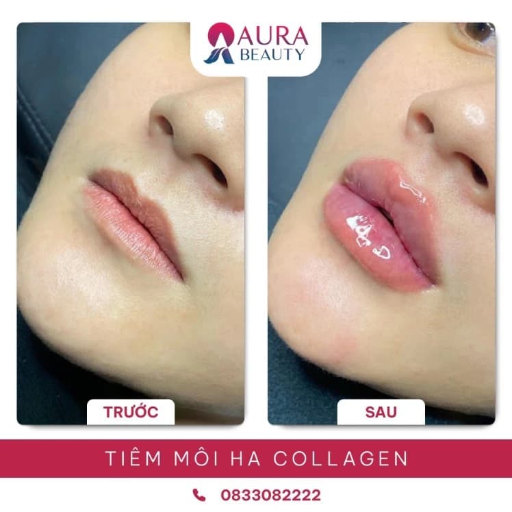 Tiêm môi HA collagen tại Thẩm mỹ Aura