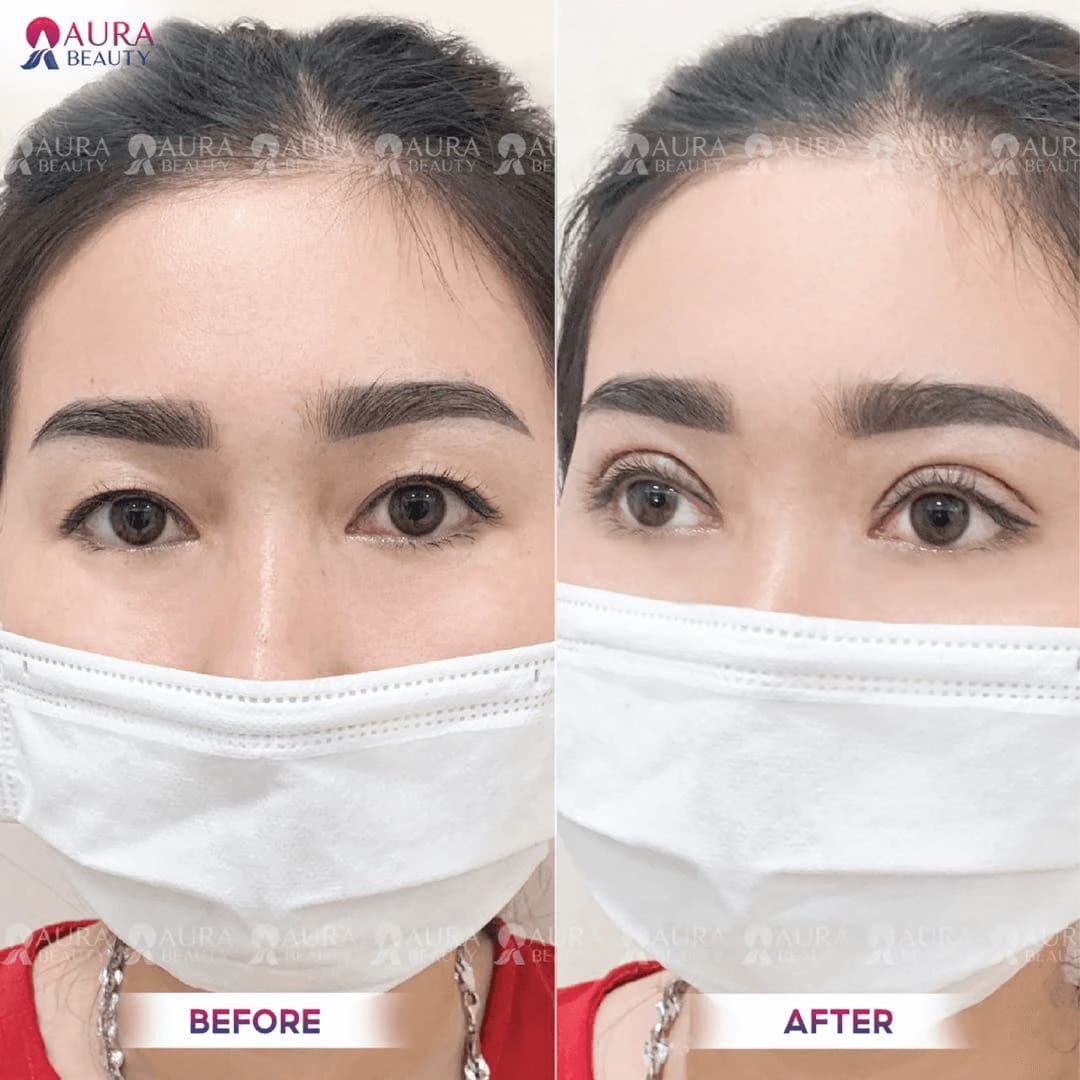 Thẩm mỹ tạo hình mắt