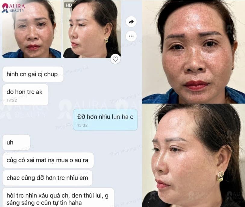 Hướng dẫn cách làm nghệ ngâm mật trong trị nám hiệu quả, an toàn tại nhà