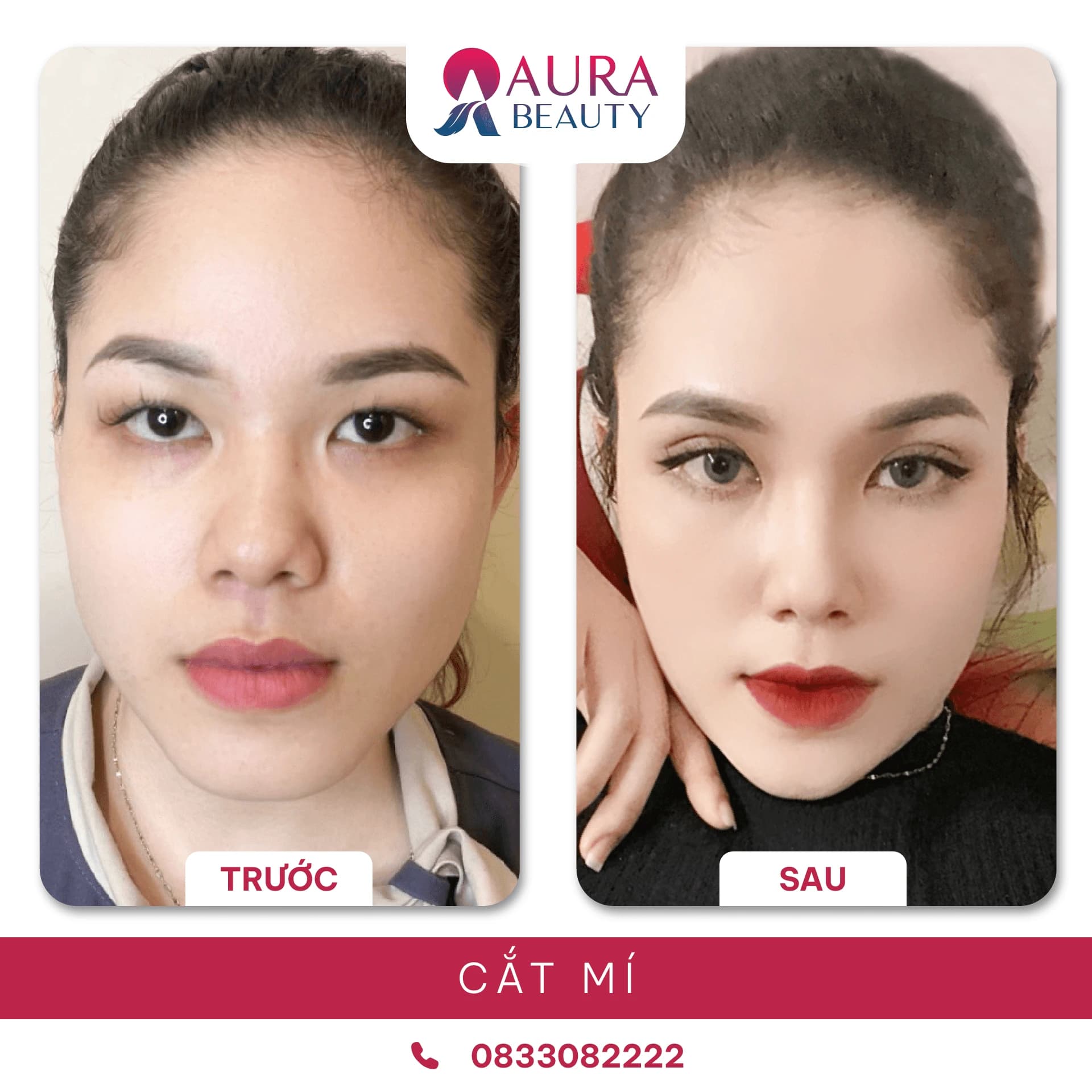 Cắt mí