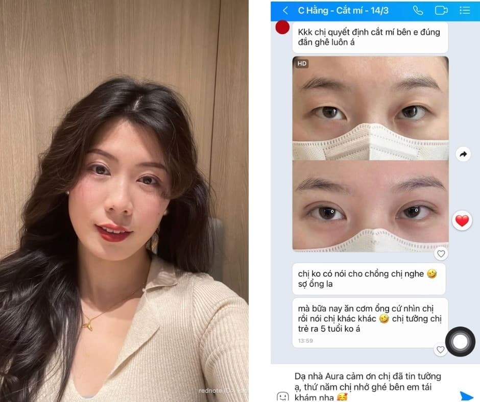 Feedback cắt mí tại Thẩm mỹ viện Aura cực kỳ chất lượng