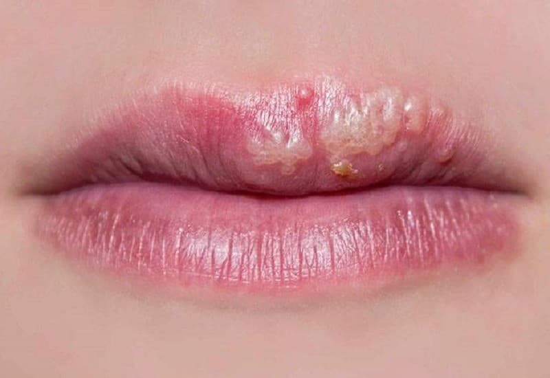 Môi có tiền sử rộp ngứa cũng khiến phun xăm bị nhiễm trùng