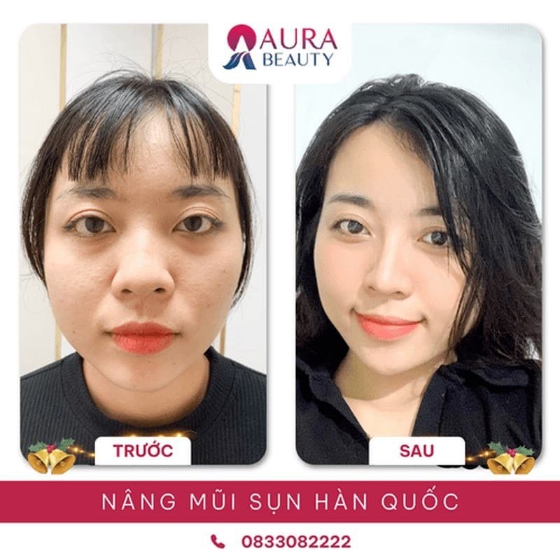 Khách hàng nâng mũi tại Aura