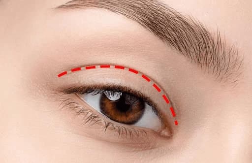 Chi phí cắt mí mắt không cố định mà phụ thuộc vào nhiều yếu tố