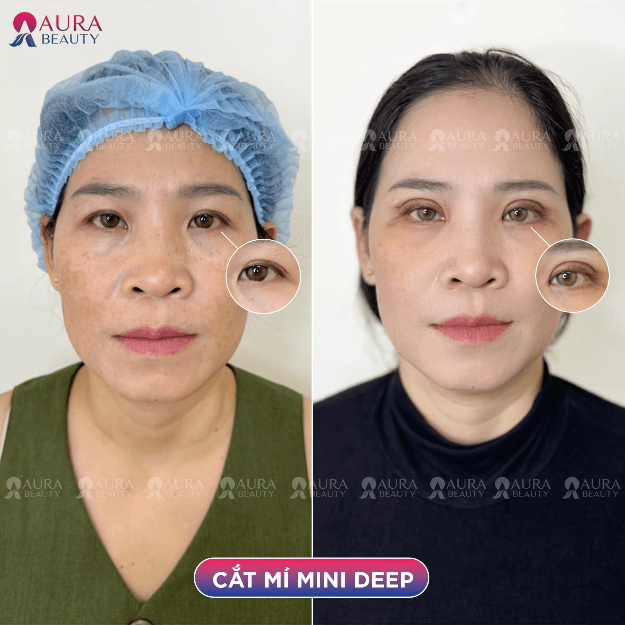 Thẩm mỹ tạo hình mắt