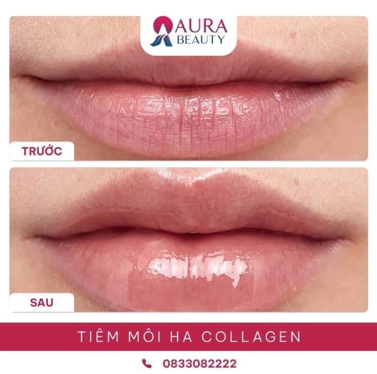 Tiêm môi HA collagen tại Thẩm mỹ Aura