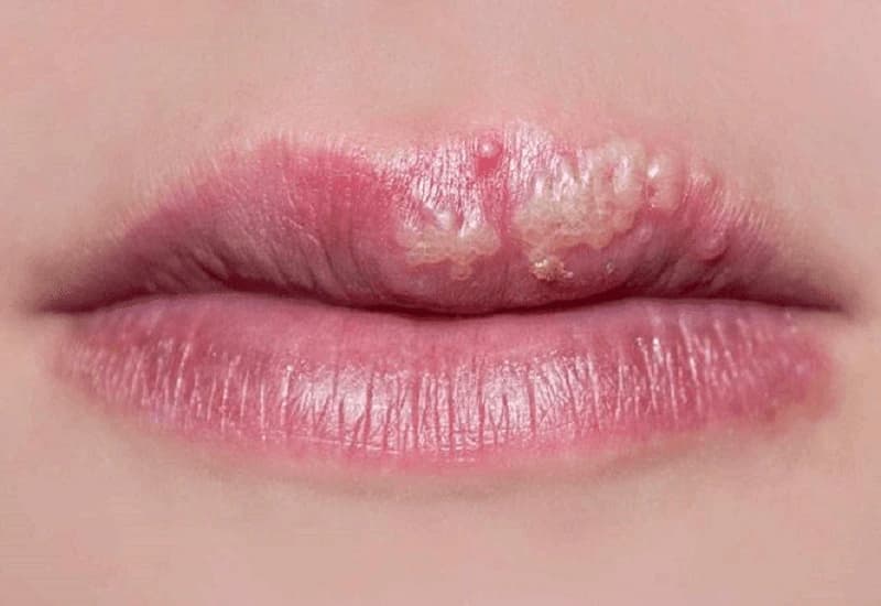 Phun môi bị mụn nước nếu không chăm sóc, xử lý đúng cách có thể gây sẹo