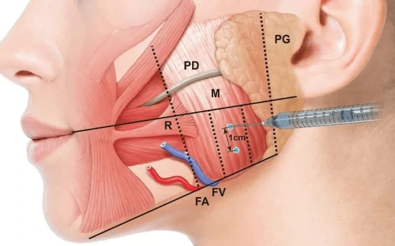 Tiêm botox gọn hàm là việc ức chế tín hiệu thần kinh truyền tới cơ cắn