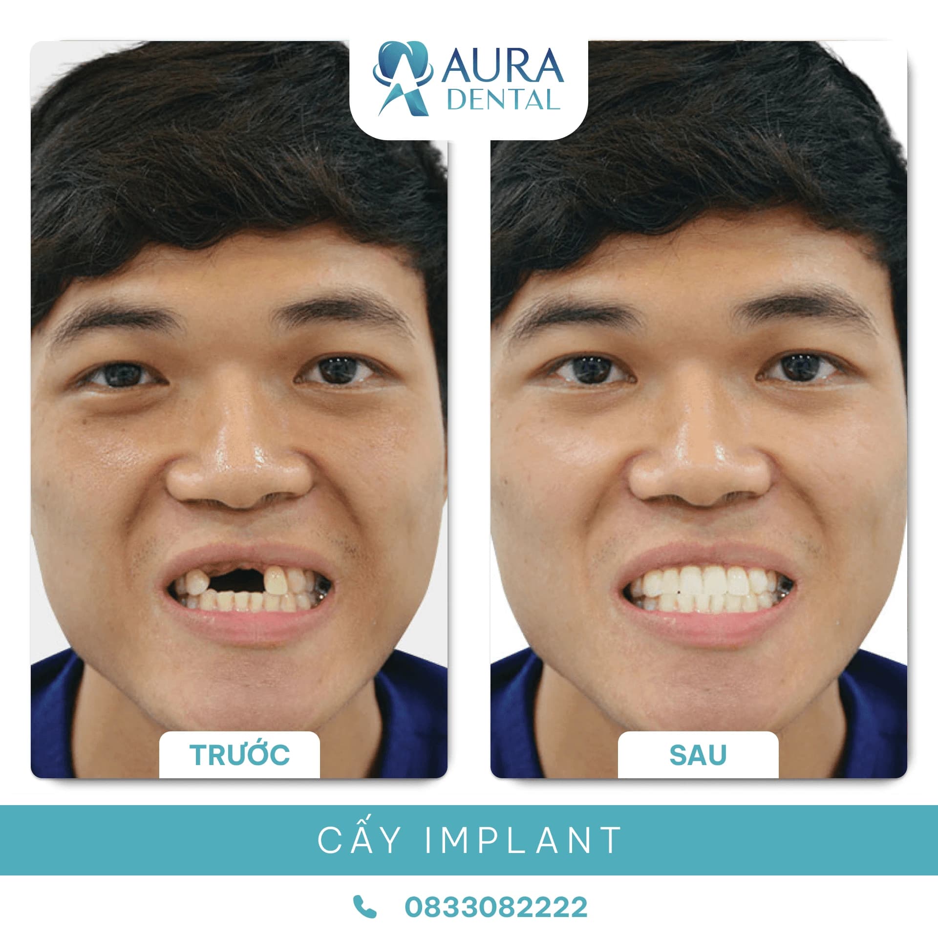 Cấy Ghép Implant