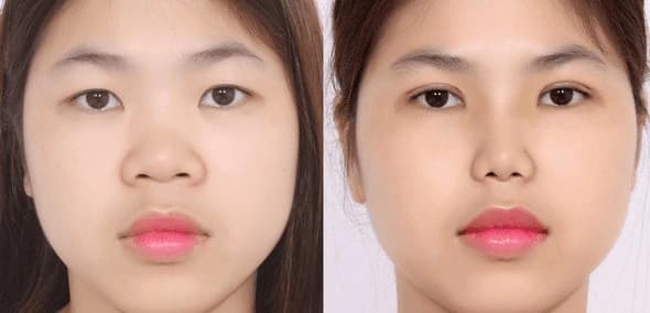 Phẫu thuật cắt mí là một tiểu phẫu thẩm mỹ nhằm tạo hình nếp mí mới