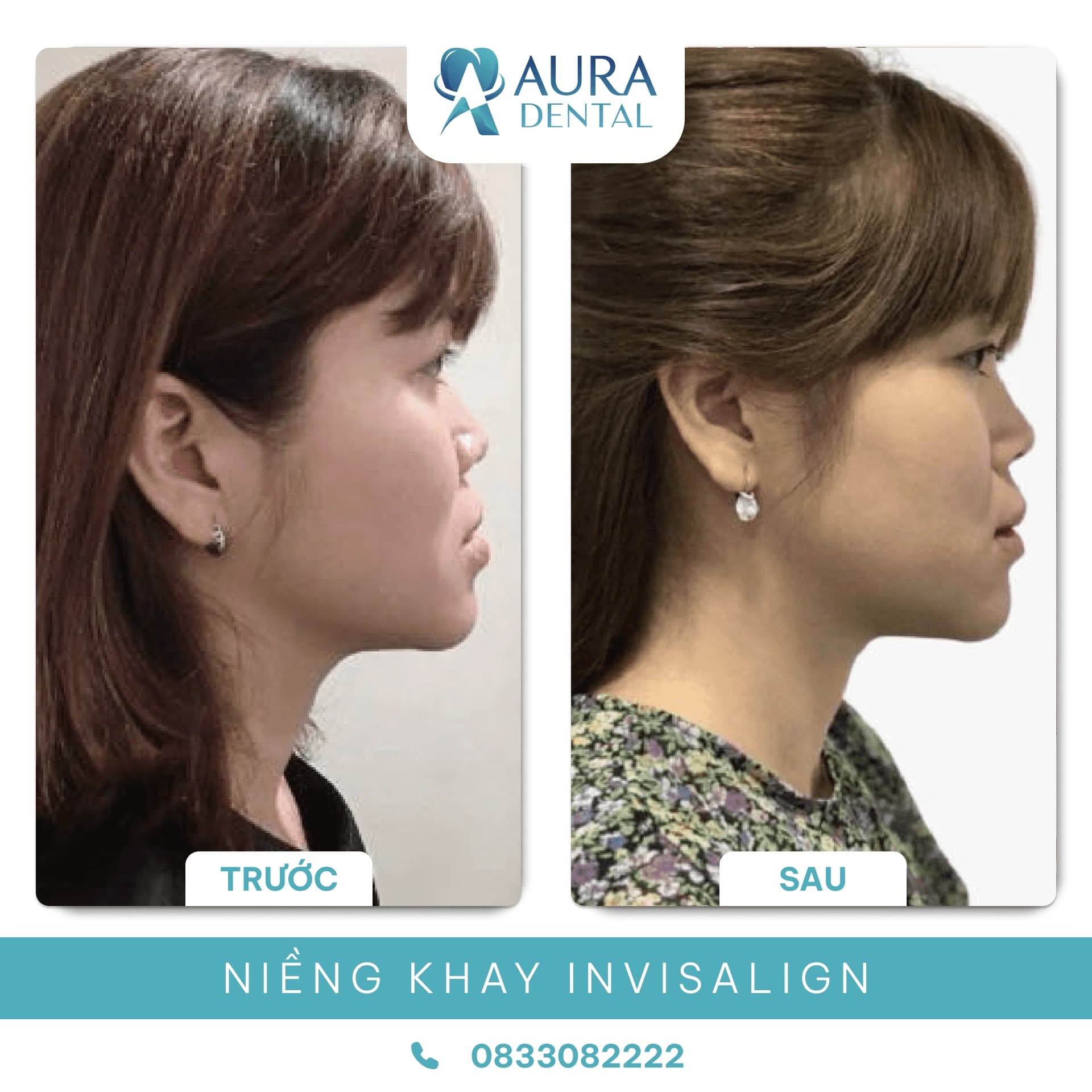 Niềng Răng Trong Suốt
