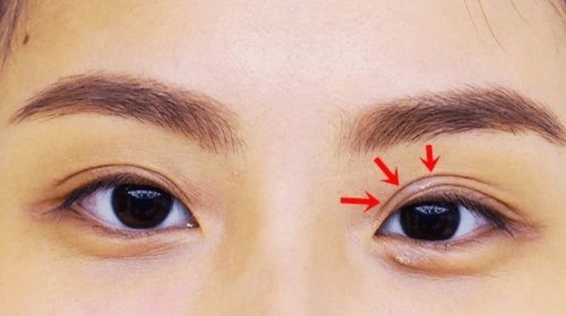 Kết hợp giữa chăm sóc khoa học và sinh hoạt hợp lý để mí nhanh lành