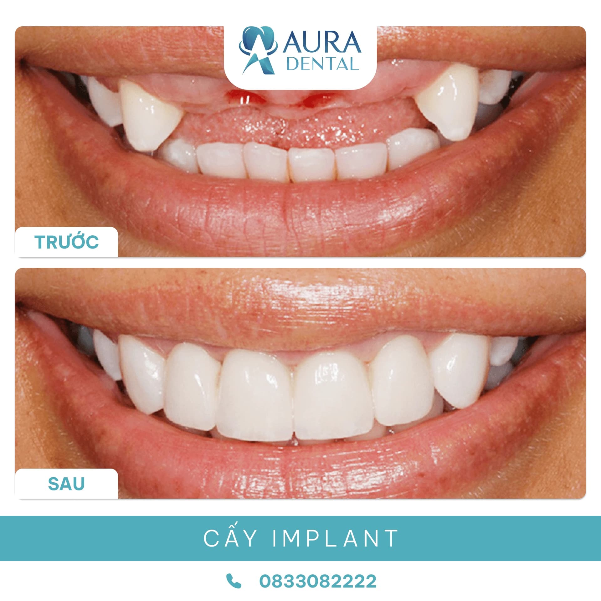 Cấy Ghép Implant