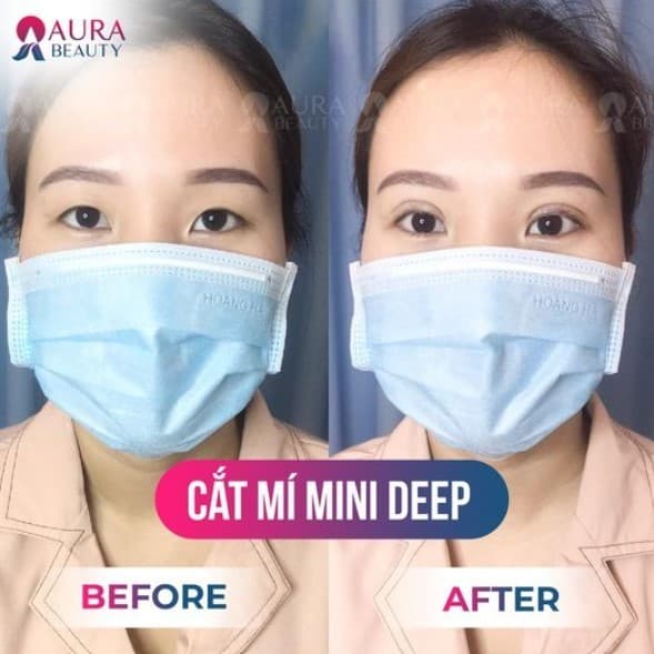 Dịch vụ nhấn mí Mini Deep tại Aura