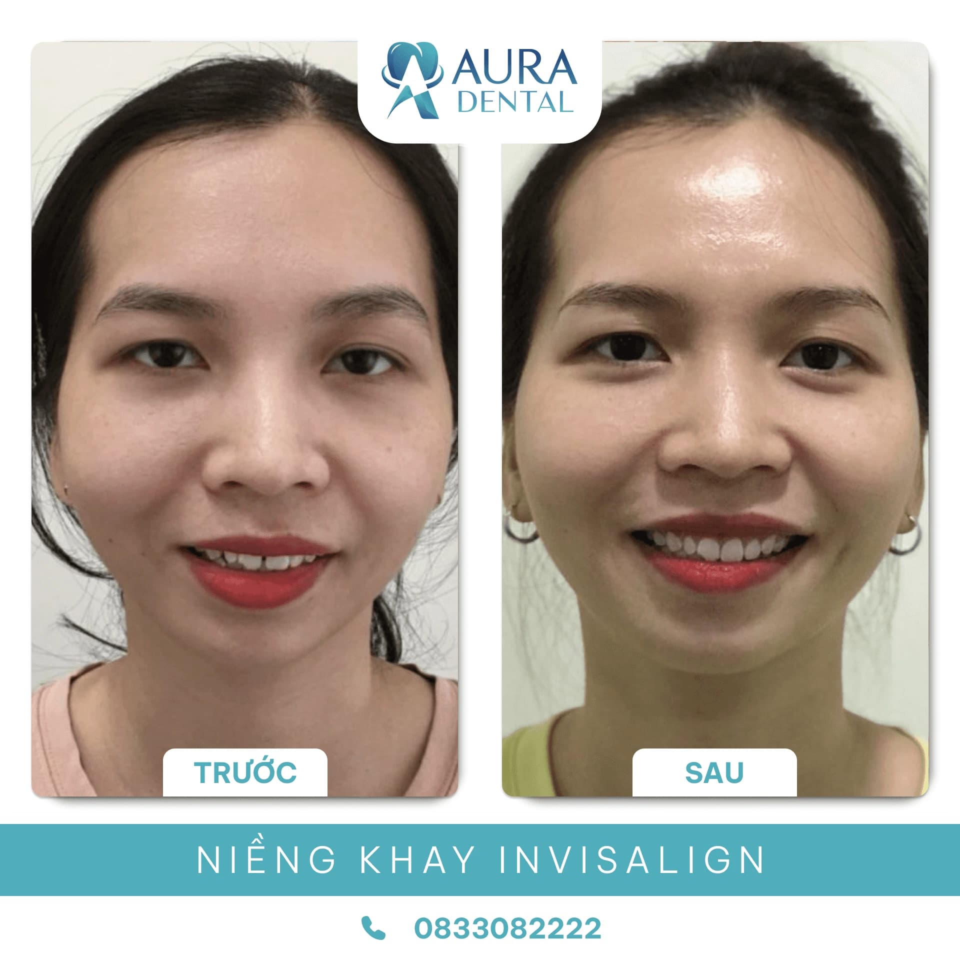 Niềng Răng Trong Suốt