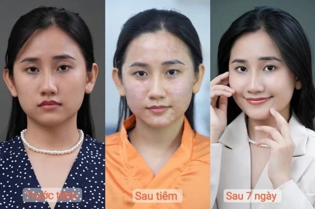 Làn da trước và sau khi tiêm meso