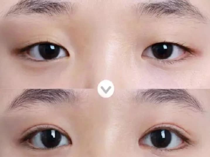 Nên kiêng hải sản trong khoảng 2 tuần sau khi nhấn mí