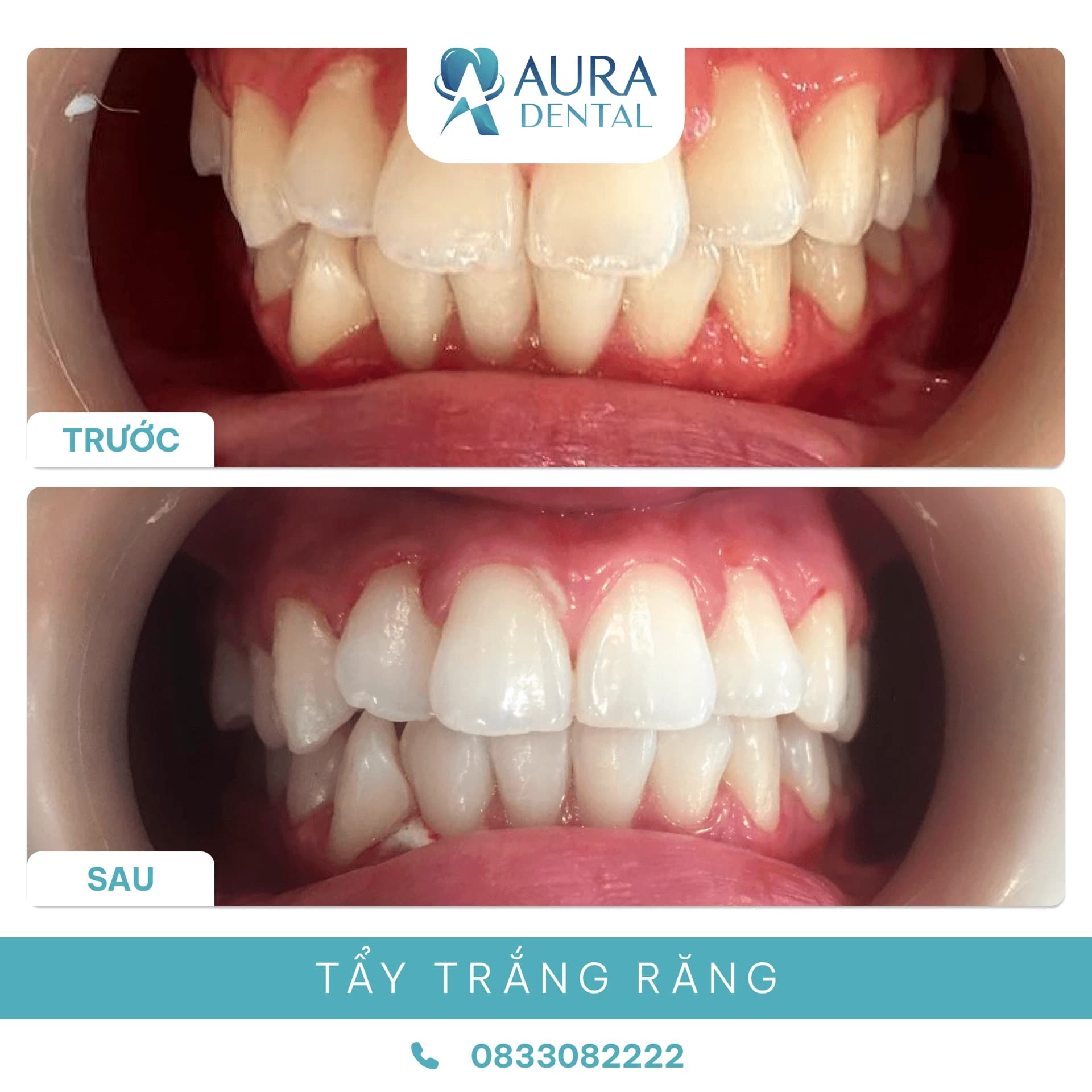Tẩy trắng răng