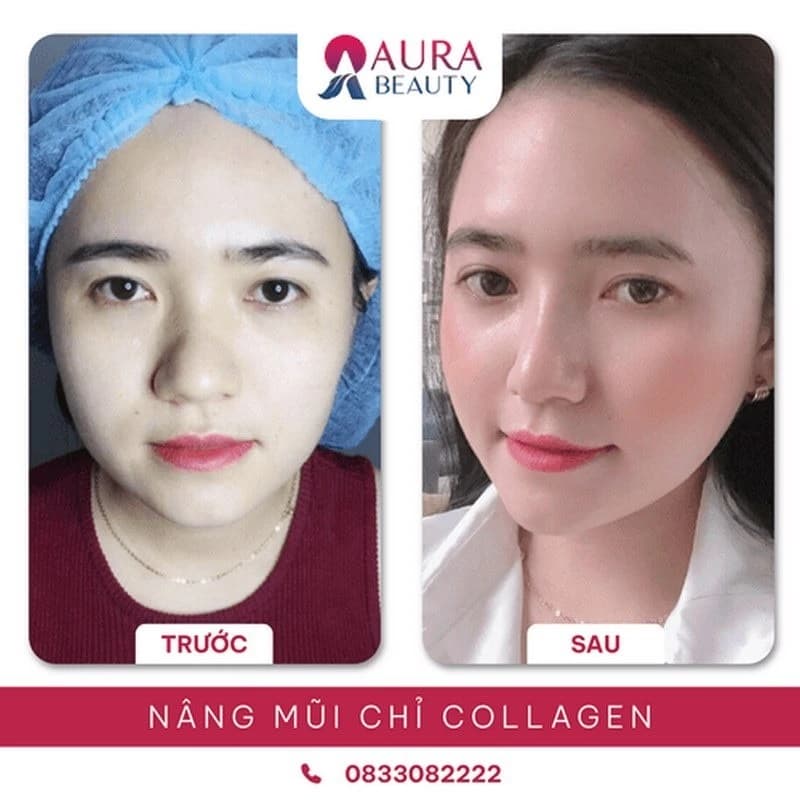 Khách hàng nâng mũi tại Aura