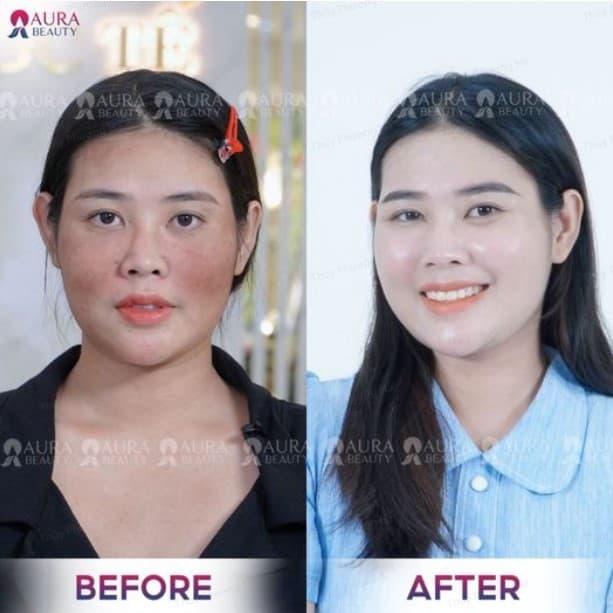 Giải quyết dứt điểm nám chỉ sau 1 liệu trình tại Aura