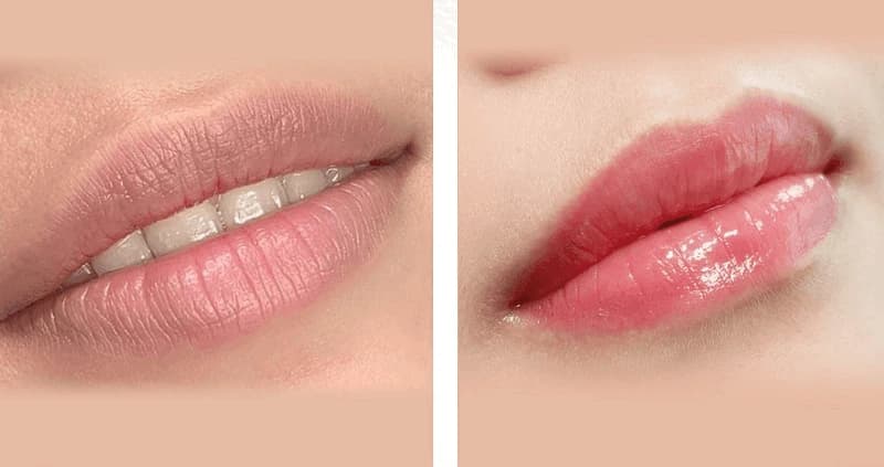 Kết quả trước và sau khi khử thâm môi tại Thẩm mỹ viện Diva