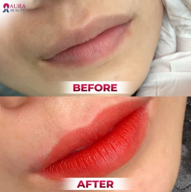 Khách hàng cấy môi sinh học tại Aura