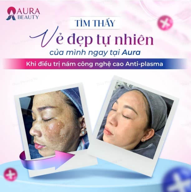 Hình ảnh sau khi trải nghiệm công nghệ trị nám Anti - Plasma
