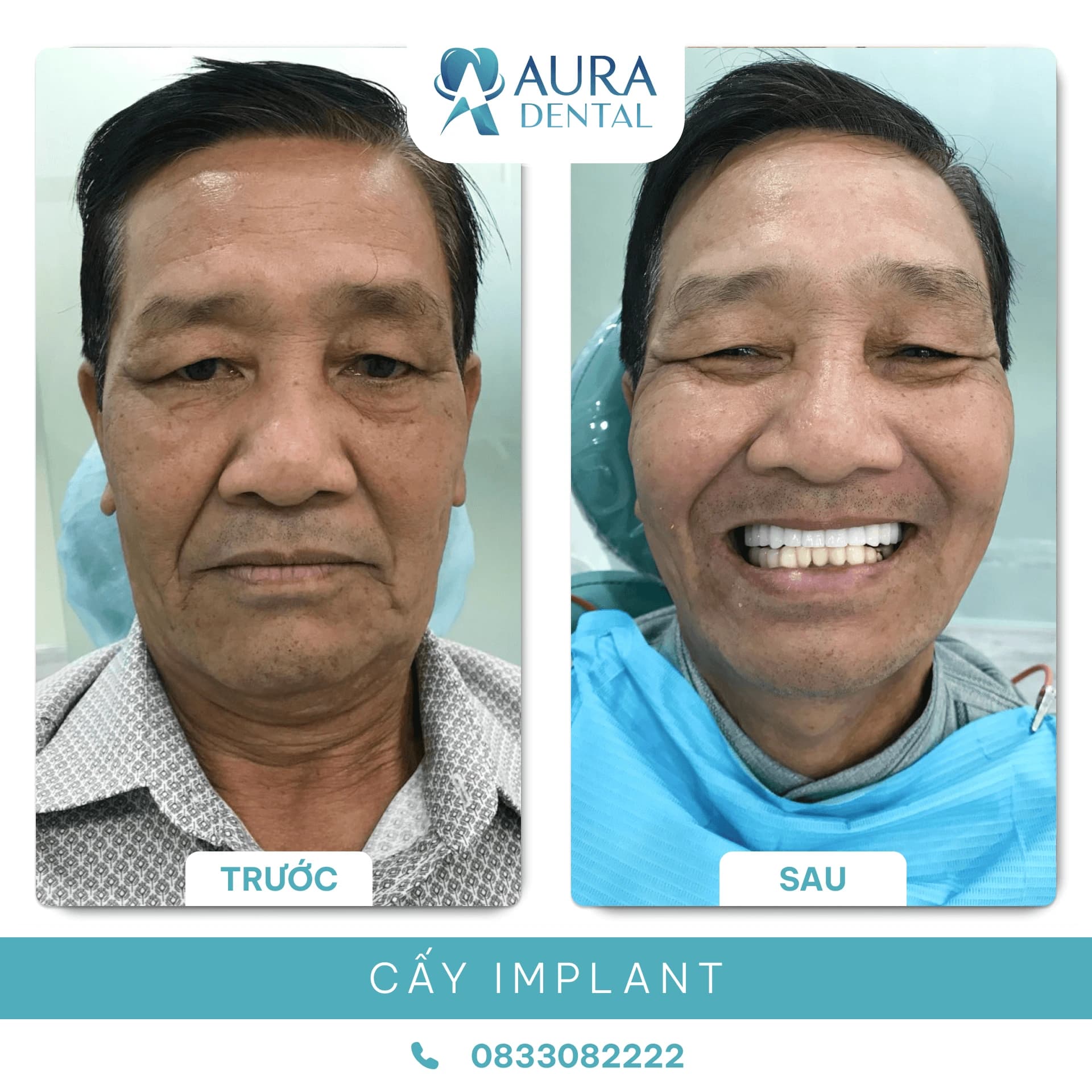 Cấy Ghép Implant