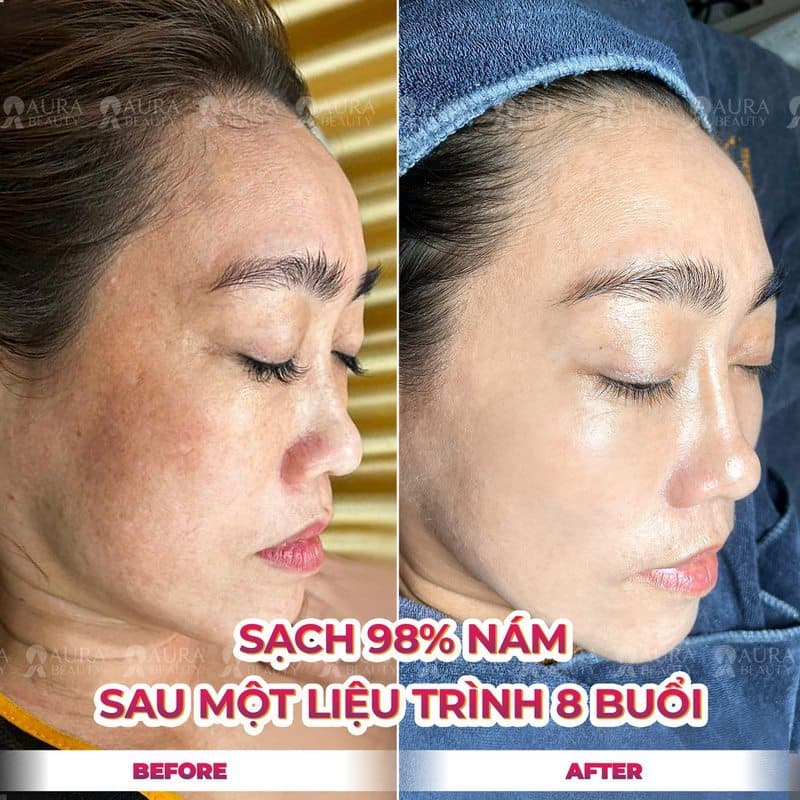 Loại bỏ nám bằng công nghệ Multi Layer Melasma