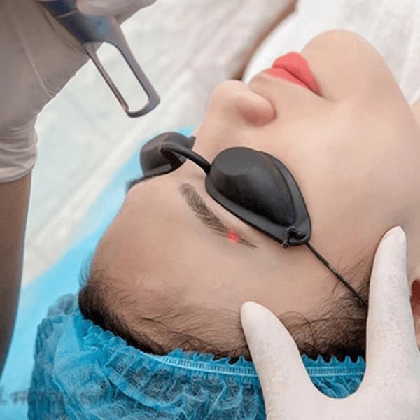Một trong những cách xử lý chân mày trổ đỏ phổ biến hiện nay là sử dụng tia laser với bước sóng phù hợp