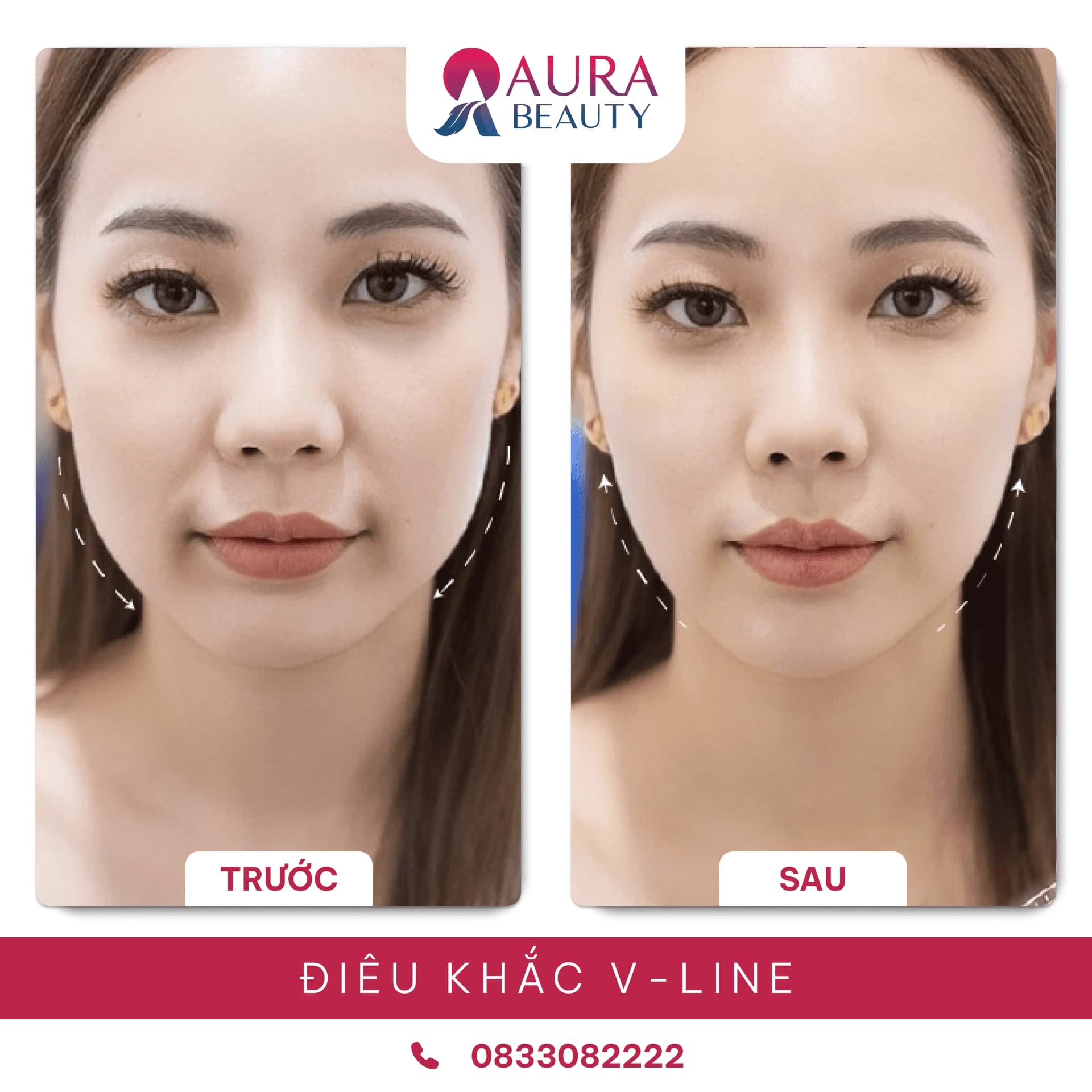 Điêu khắc tạo hình mặt V-Line