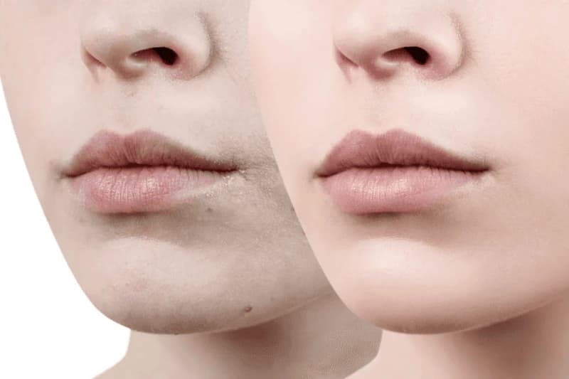 Môi thâm được chia thành các cấp độ khác nhau
