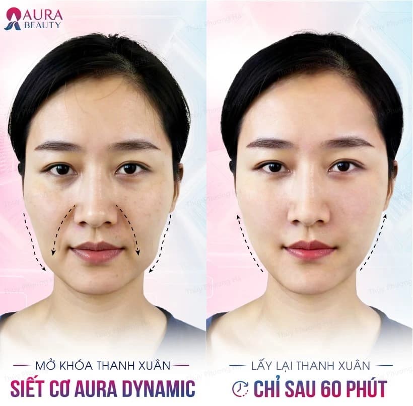 Siết cơ nội soi Aura Dynamic giúp làn da sẽ trở nên săn chắc, mịn màng