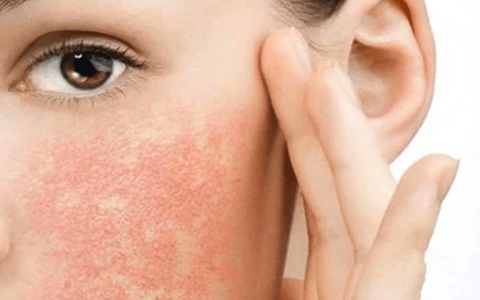 Những ai có cơ địa dị ứng với collagen không nên siết cơ nội soi