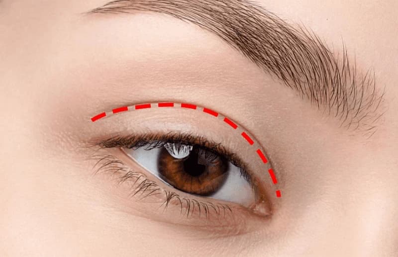 Thời gian duy trì nếp mí có thể kéo dài từ 3 - 5 năm