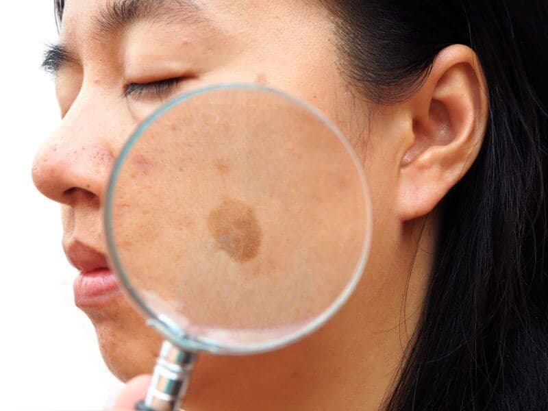 Tìm hiểu các loại nám da: Nguyên nhân và cách điều trị