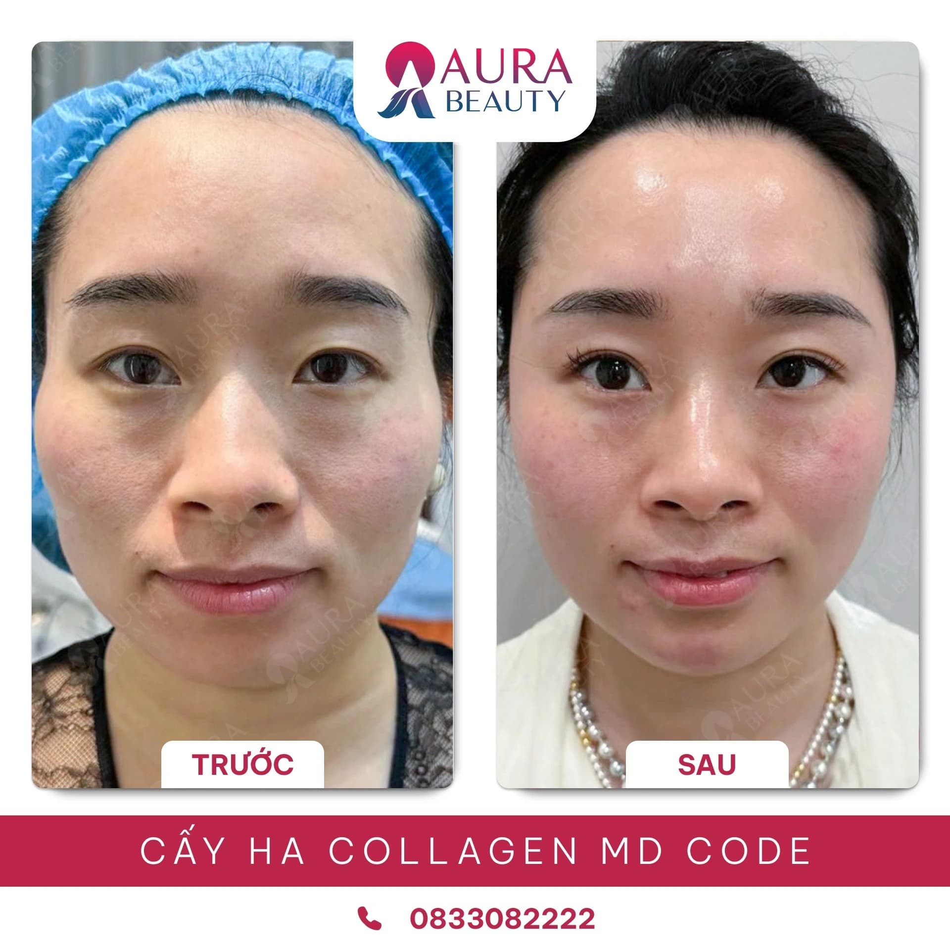 Hình ảnh khách hàng trước và sau khi sử dụng dịch vụ MD Code làm đầy má hóp tại thẩm mỹ Aura