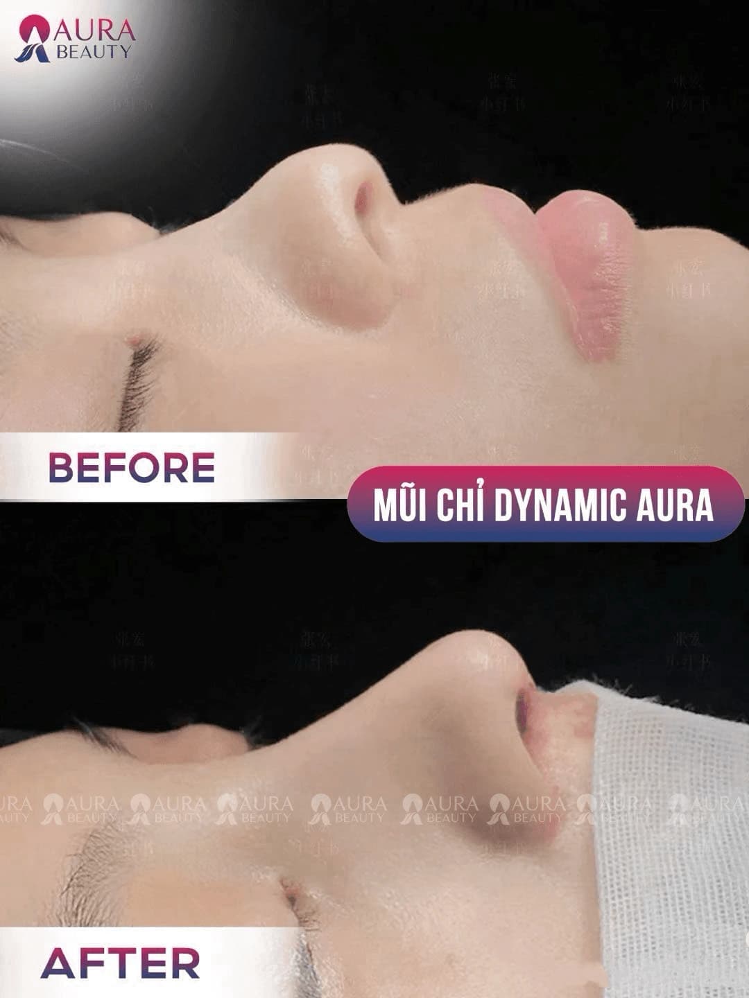 Thẩm mỹ tạo hình mũi