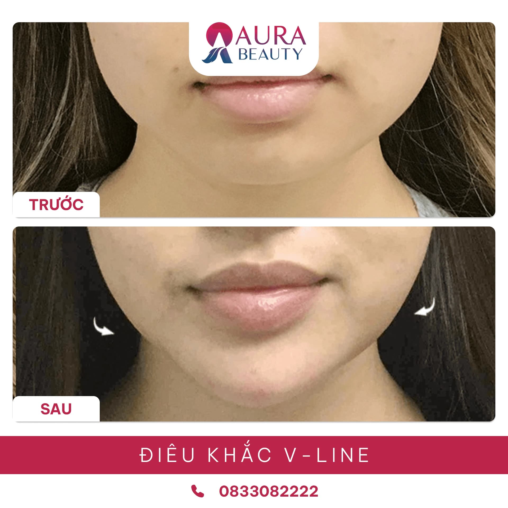 Điêu khắc tạo hình mặt V-Line