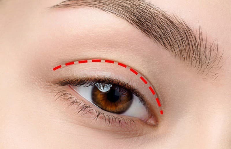 Nhấn mí là phương pháp thẩm mỹ hiện đại, ít để lại biến chứng hay đau nhức