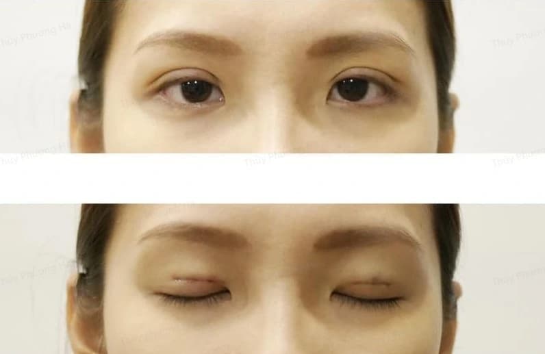 Tránh chà xát hoặc đụng chạm vào mắt để không làm xô lệch mí