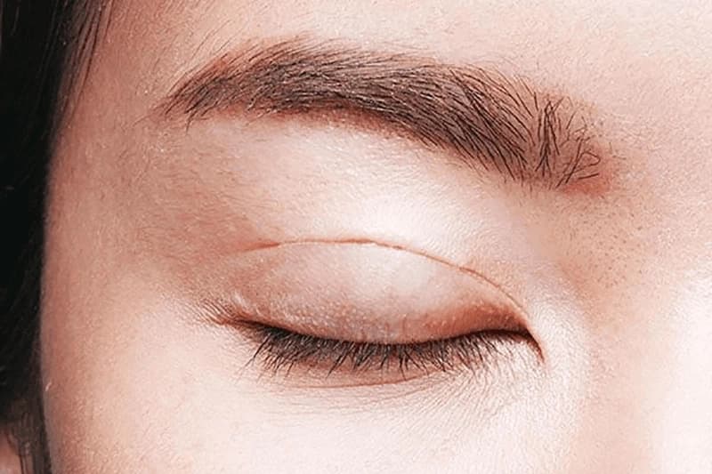 Cắt mí là tiểu phẫu tác động bên ngoài vùng mí, không xâm lấn sâu nên thời gian hồi phục thường khá nhanh, chỉ khoảng 7–10 ngày.