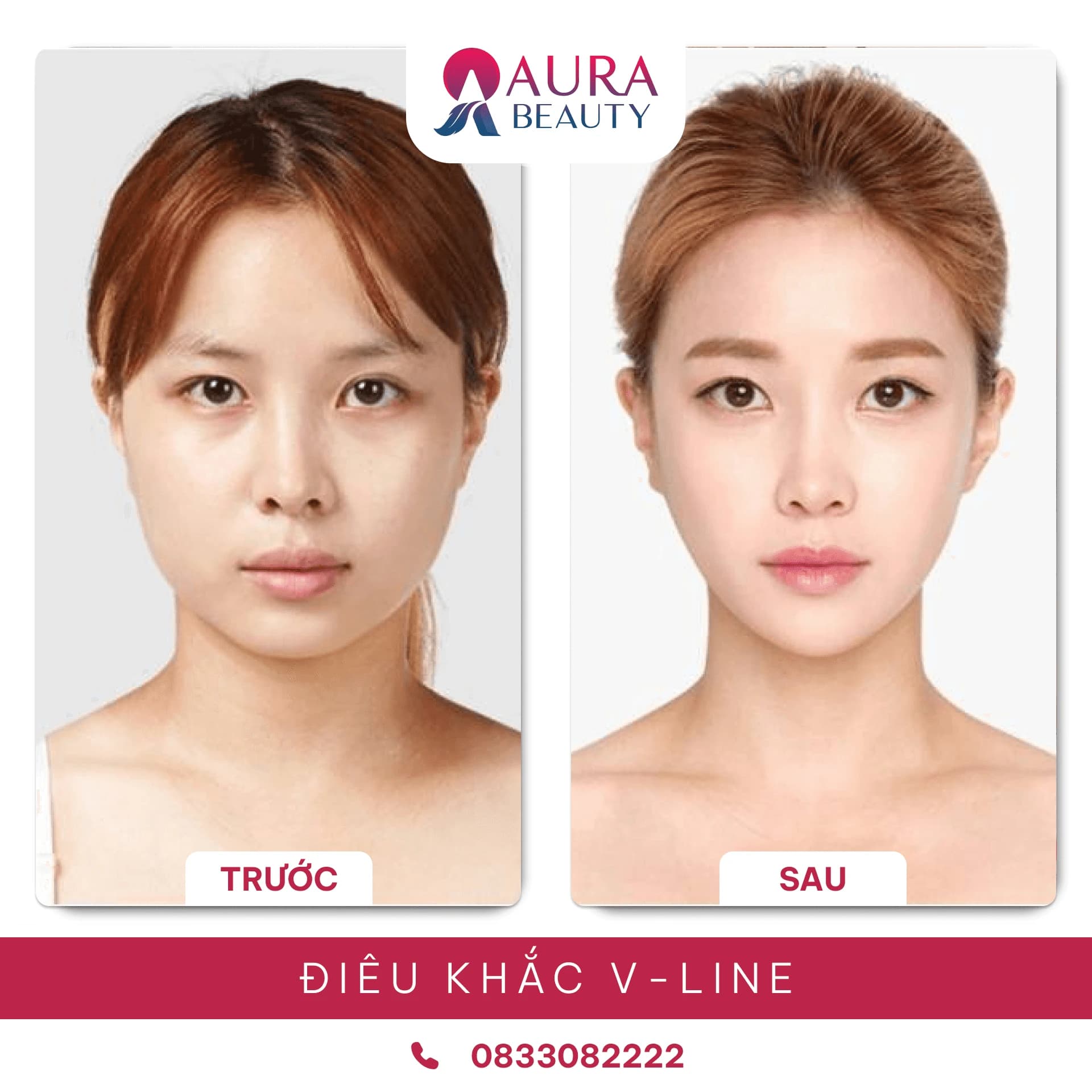 Điêu khắc tạo hình mặt V-Line