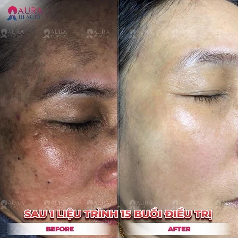 Khách hàng trị nám tại Aura