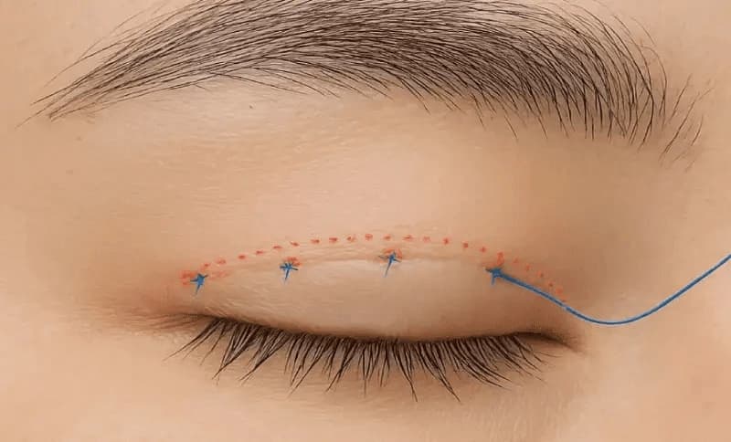Cần chăm sóc cẩn thận để nếp mí nhấn được tự nhiên